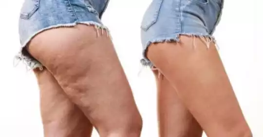 cellulite21.jpg